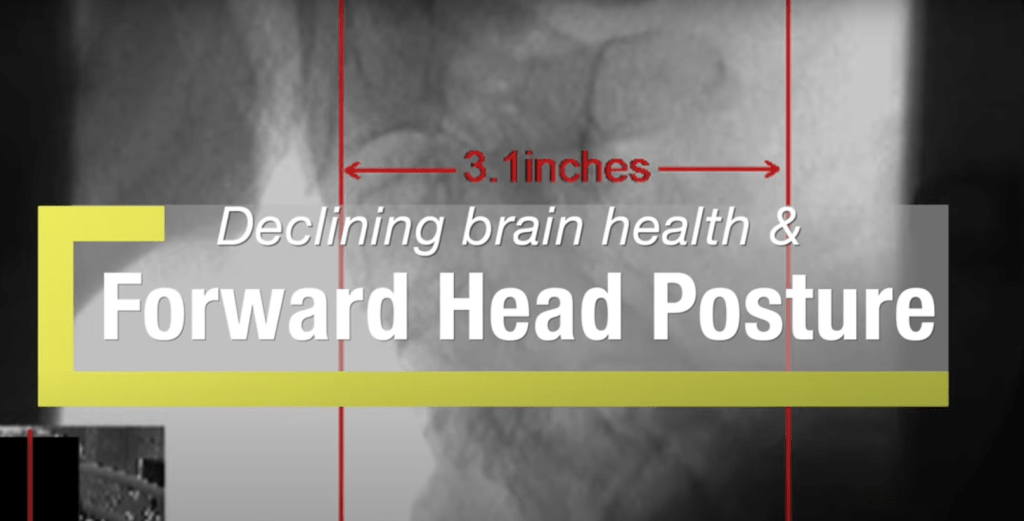 Forward Head Posture